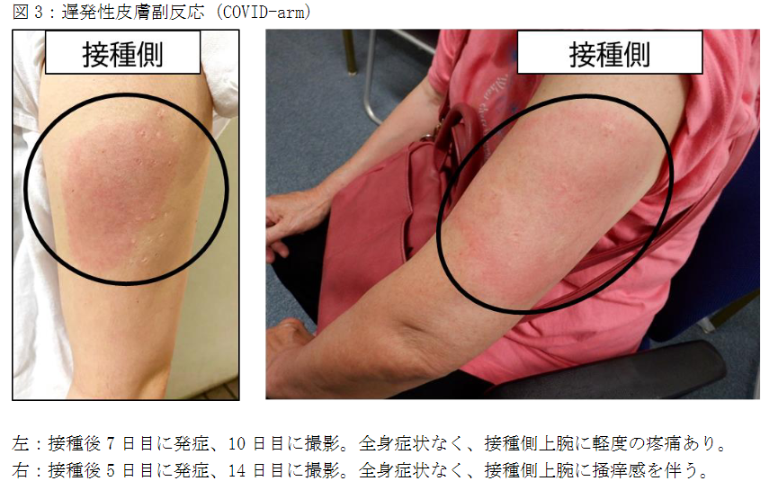 画像に alt 属性が指定されていません。ファイル名: モデルナアーム-1.png